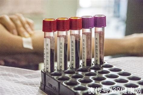 东莞工厂体检抽血项目检查什么