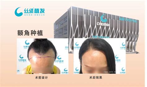 中国最好的毛发种植医院
