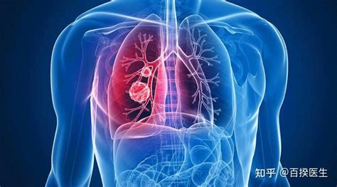 为什么肺癌是全球头号的癌症