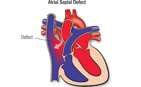 先天性心脏有反流会影响生命吗