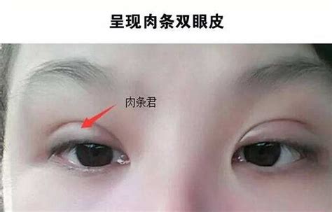 双眼皮手术后眼部淤青怎么消除