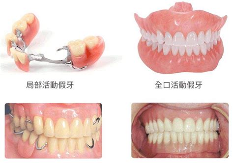 固定义齿有哪几种