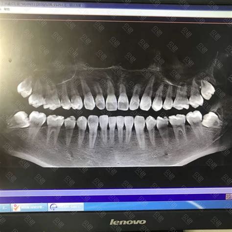 备孕中去拍了牙齿x光片