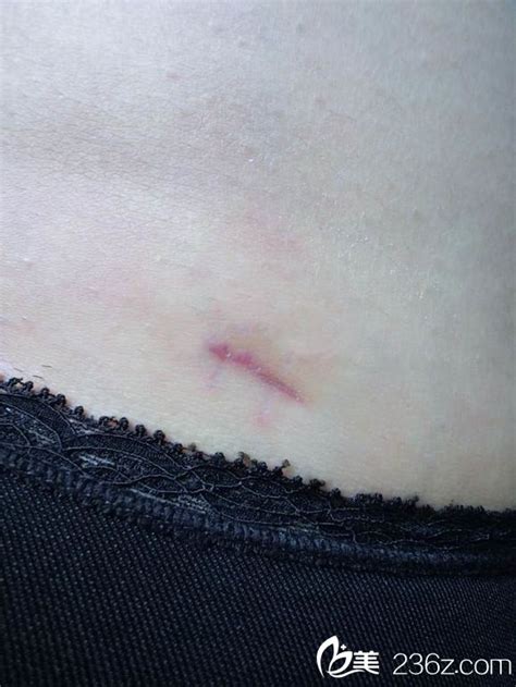 大腿抽脂后的疤痕照片