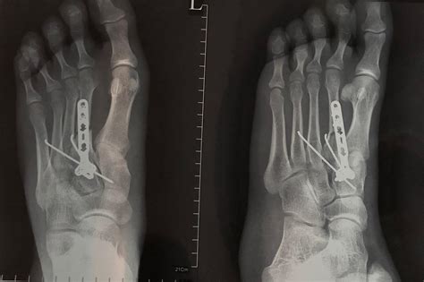 女人小腿骨折手术后多久能走路