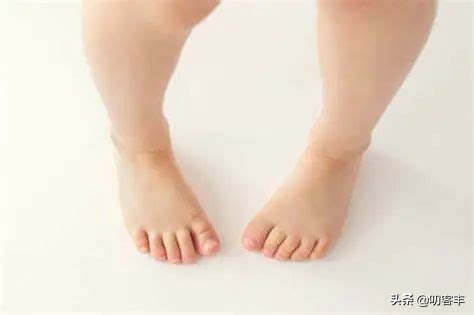 宝宝遗传性内八字腿怎么治疗