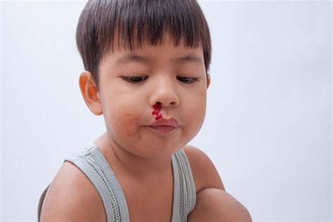 小孩流鼻血有血块