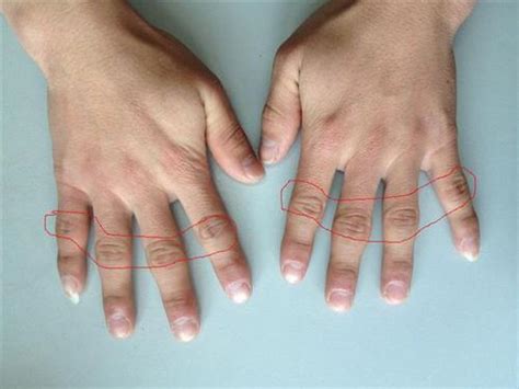 小手指关节疼原因有三