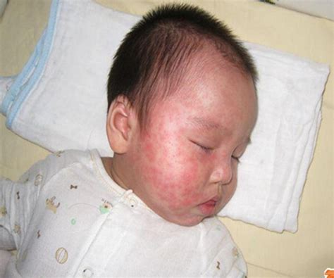 幼儿急诊疹子的护理