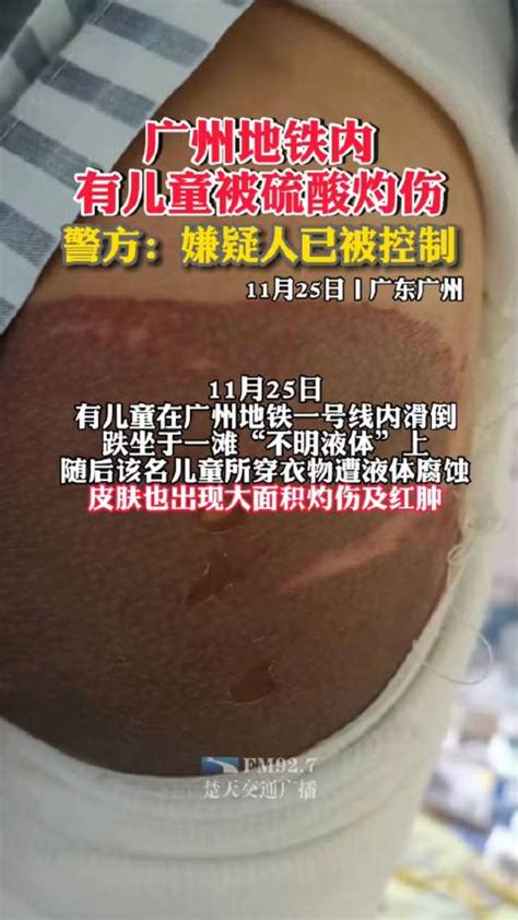 广州地铁儿童被硫酸烧伤