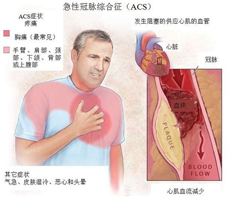 急性冠脉综合征的主要症状