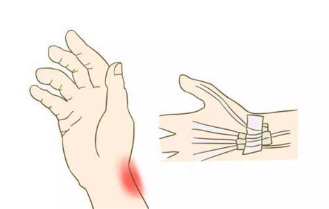 手伤筋超过3个月最快的恢复方法
