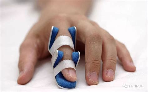 手指挫伤怎么处理最好的方法