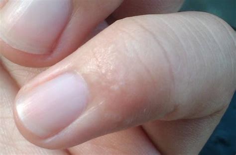 手指长水泡有透明小点
