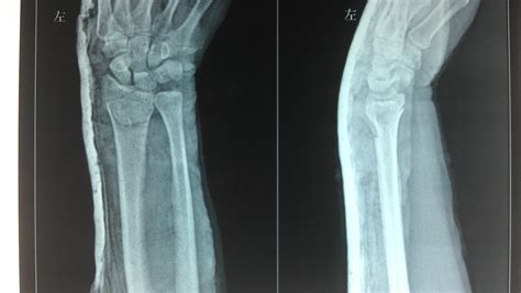 手腕骨折15天恢复到什么程度了