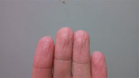 无名指尖发麻是什么原因引起的