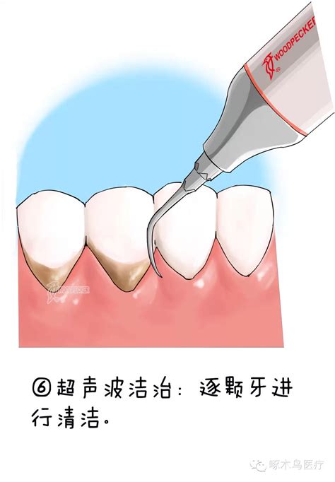 洁牙师接诊流程