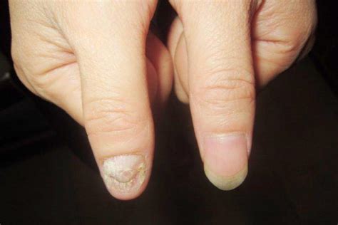 灰指甲传染潜伏期多久
