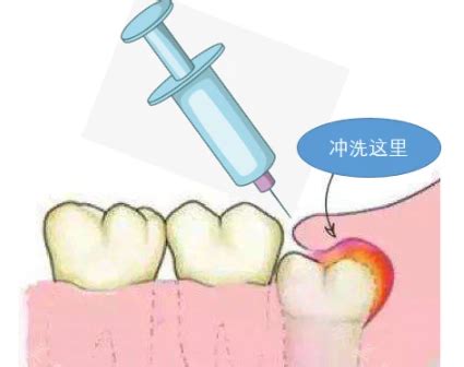 牙根脓肿切开引流需要多少钱