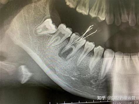 牙槽骨脓肿手术大概多少钱