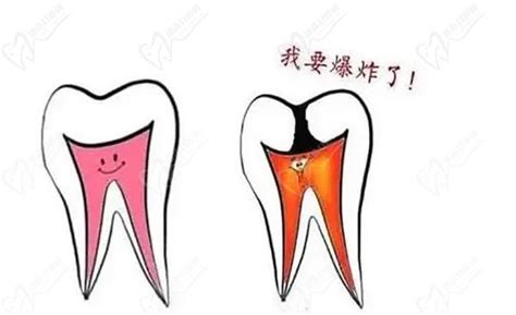 牙髓炎属于几级疼痛