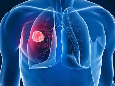 癌症发展成肺癌能活多久