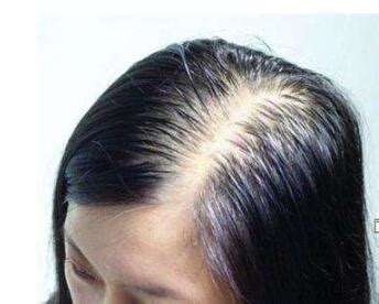 种植头发有哪些害处呢