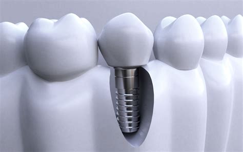 种植牙齿有多少种种法