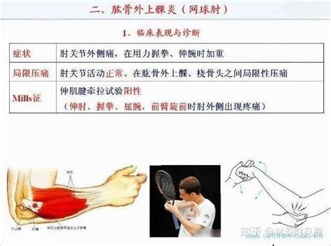 网球肘疼痛手法图