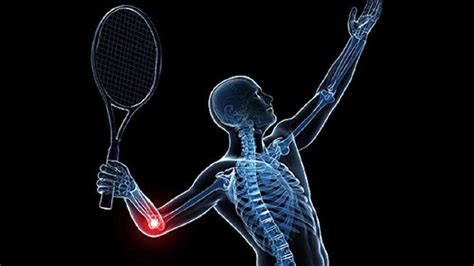 网球肘的治疗方法和技巧