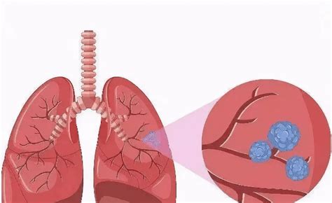 肺有多发性结节可以打新冠疫苗吗