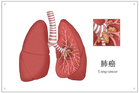 肺癌早期咳嗽的4种征兆
