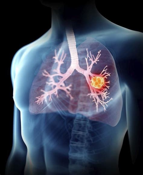 肺癌是一种致命性很强的癌症