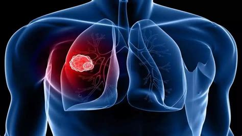 肺癌是中国第一高发癌吗