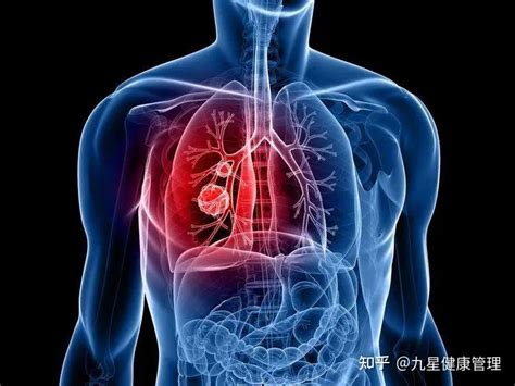 肺癌是目前全球的头号癌症杀手