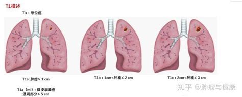 肺癌胸膜侵犯属于几期