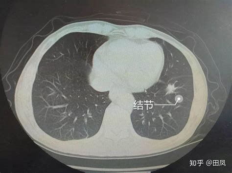 肺部影像学证据指什么