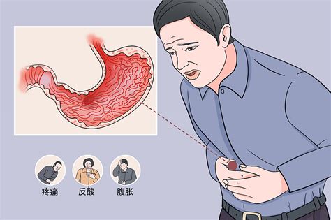 胃溃疡是大病吗