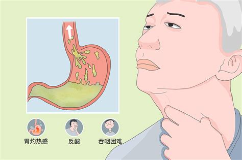胆汁反流咽喉炎