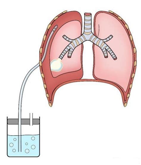 胸腔引流管怎么处理