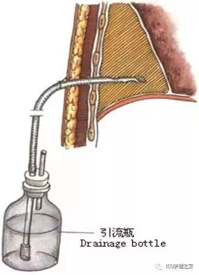 胸腔引流管排液和排气