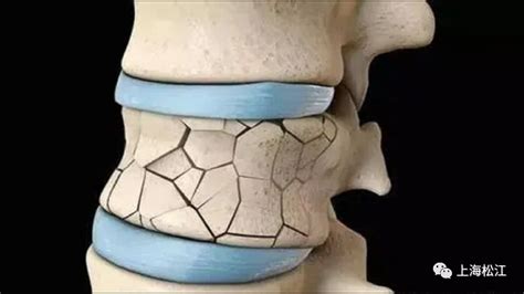 腰椎压缩性骨折戴哪种护具好一点