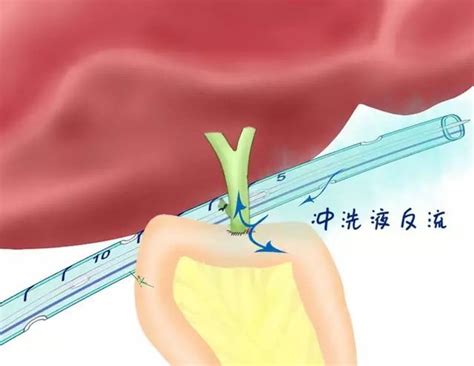 腹腔引流管渗水处理方法