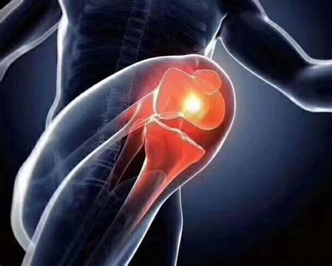 膝盖关节积液能戴护膝