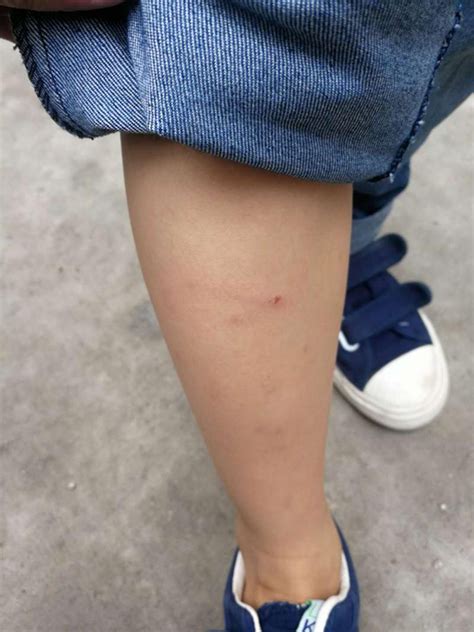 4岁男孩被狗咬头上被缝十针图片