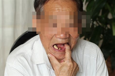 73岁老人能种牙