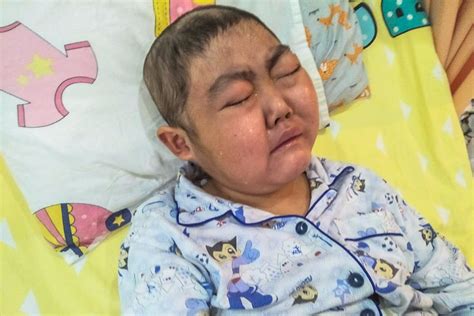 8岁男孩患全球罕见怪病