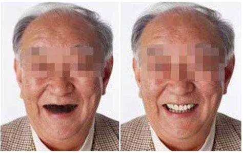 85岁老人种牙合适吗