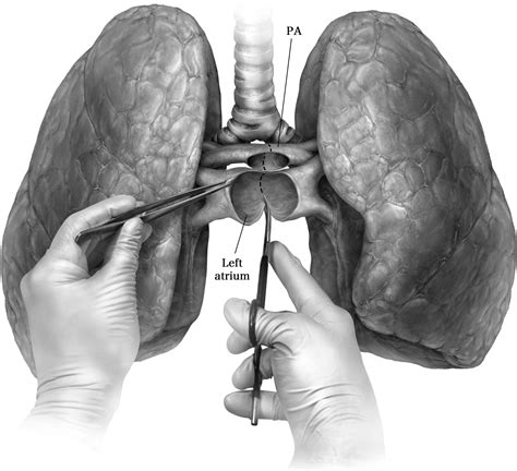 bilateral lung transplantation