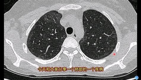 ct肺部影像诊断阳性什么意思